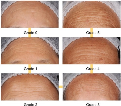 Figure 1 Clinical standardized photographic scale of “forehead pigmentation”.