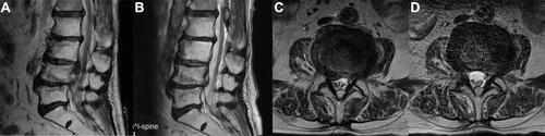 Figure 5 Comparison of preoperative and postoperative MRI, showing that disc fragments were completely removed. (A) preoperative MRI (sagittal). (B) postoperative MRI (sagittal). (C) preoperative MRI (axial). (D) postoperative MRI (axial).