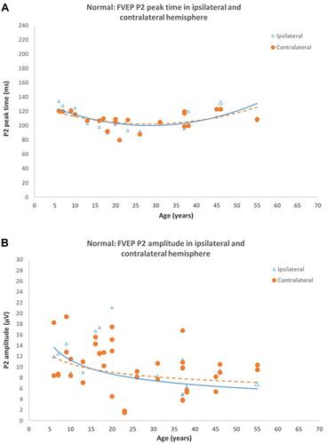 Figure 4 Normal Flash VEPs (A) P2 peak time in ipsilateral and contralateral hemispheres of control subjects. Peak times from both hemispheres are symmetrical and shorten until approximately 18–20 years of age, do not change between 20–40 years of age, then increases beyond 40 years of age (B) P2 amplitude in ipsilateral and contralateral hemispheres of control subjects. P2 amplitudes from both hemispheres are symmetrical and reduce significantly with age (P < 0.05). Reprinted from Neveu MM, Jeffery G, Burton LC, Sloper JJ, Holder GE. Age-related changes in the dynamics of human albino visual pathways. Eur J Neurosci. 2003;18(7):1939–1949.Citation110