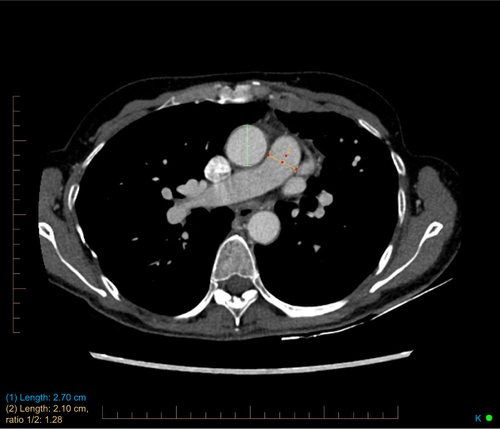 Figure S3 PA/A ratio measurement.Notes: Intravenous contrast-enhanced CT image of a 61-year-old male subject with measurements of the ascending aorta (green) and main pulmonary artery (yellow) at the level of the right pulmonary artery ostia. PA/A ratio: 1.28.Abbreviations: CT, computed tomography; PA/A, pulmonary artery to aorta.