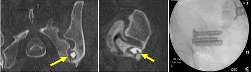 Figure 4 (Case 3): Yellow arrows point to placement of the SA into the ilium and not the joint space. Patient underwent successful revision using one threaded and two triangular porous devices.