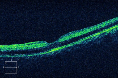 Figure 3 A horizontal, cross-sectional OCT tomogram through the fovea disclosed diffuse thickening of the neurosensory retina.