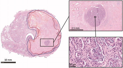 Figure 3. Histological analysis of prostatic thermal injury. An annotated axial H&E-stained whole-mount slide mid from the RALP specimen of the patient four showing the complete irreversible cell death inside the red boundary (CNZ) and margin zone between red and blue boundaries (MZ). Magnification H&E images from thermally-fixed area show well preserved morphology of Gleason 4 adenocarcinoma.