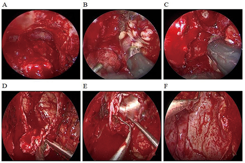 Figure 2 The main surgical procedures for resection of malignant tumors of the anterior skull base. (A) The frontal sinus was contorted and the anterior skull base was exposed. (B) The left extraconal fat invaded by the tumor was excised. (C) The left anterior ethmoidal artery was blocked. (D) The involved dura was successfully isolated and resected. The fascia lata of the thigh (E) and the Hadad-Bassagasteguy flap (F) were successively covered to reconstruct the anterior skull base.