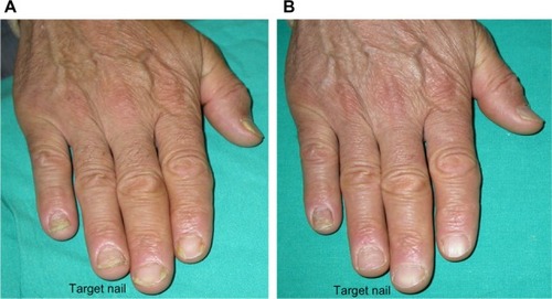 Figure 5 Onycholysis and leukonychia completely resolved, and improvement of nail plate crumbling compared to baseline.