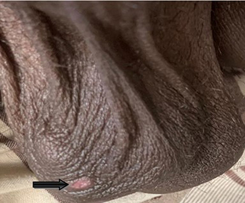 Figure 2 Unilateral ulcerated nodule in testis.