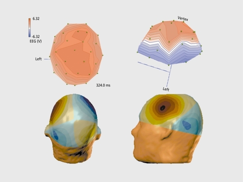 Figure 2. Topographic distribution of P300 responses. Top: electrical activity from scalp electrodes top view (left) and lateral view (right) of the left surface with the nose pointing toward the left. Bottom: the same as above, but for the magnetic measurement at several millimeters from the scalp. EEG, electroencephalography.