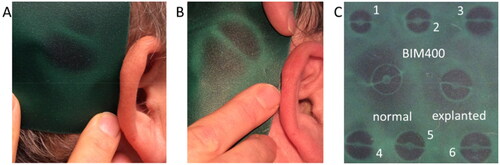 Figure 2. Magnetic field visualization with a flux detector film (M-08 supermagnete webcraft, Uster, Switzerland). (A) The condition of the diametral magnet before revision surgery is asymmetric with lower magnetization of the upper magnetic field. (B) One year after revision surgery shows symmetric magnetization. (C) The visual comparison with external magnets (1–6), normal and explanted BIM400 magnet shows asymmetry of the explanted diametral magnet.