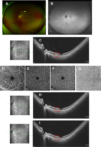 Figure 1 Fundus images of the left eye in case 1. Fundus photography (A) and fundus autofluorescence (B) were normal. OCT disclosed hyper-reflective segments of OPL and ONL, and associated disruption of ellipsoid, interdigitation zones, and RPE layers on the nasal macular area ((C), red box). No flow defects were observed in the superficial (D)/intermediate (E)/deep (F) retinal capillary plexuses and choroidal capillary plexus (G) on OCTA. One week after oral prednisone administration OPL and ONL hyper-reflectivity mildly faded with definable ellipsoid, interdigitation zones, and retinal pigment epithelium (RPE) layers ((H), red box). Six weeks later only slight irregularity of ellipsoid, interdigitation zones and RPE layers persisted on OCT ((I), red box).