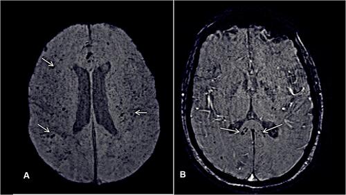 Figure 6 53-year male patient with history of COVID-19 induced ARDS and prolonged ICU stay. Follow-up (12 weeks after discharge) MRI brain for altered sensorium shows presence of multiple microbleeds on SWI images seen as multiple hypointense foci (white arrows) predominantly at grey-white matter junction (A) and corpus callosum (B) likely suggestive of critical illness induced microbleeds.