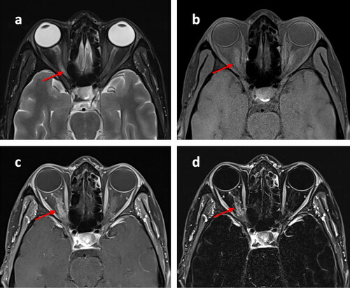 Figure 2. Axial T2 MRI of the orbits showing a swollen hyperintense right optic nerve (a). Axial T1 FS pre-contrast (b), post-contrast (c), and subtraction (d) MRI of the orbits, showing right optic nerve post-contrast enhancement. Right optic nerve is highlighted with arrows.