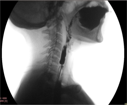 Figure 3 Lateral view of barium swallow study in a patient with circumferential web with severe narrowing producing “jet phenomenon” below the level of narrowing because of the web.