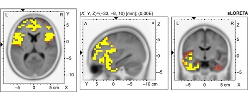 Figure 3 Voxel-wise statistical nonparametric map of sLORETA images in OCD patients with cognitive impairment (N=11) compared to healthy controls at the 0.05 significance level after correction for multiple comparisons.