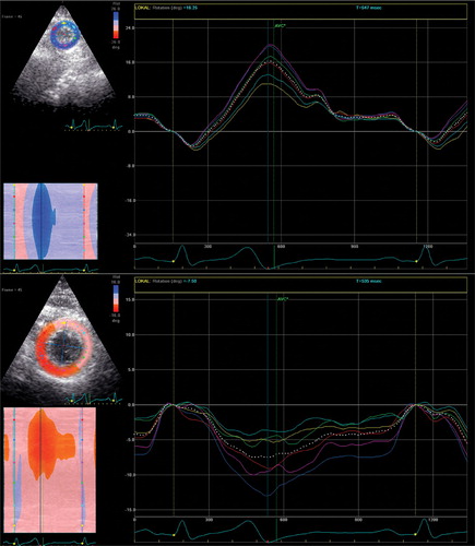 Figure 1 Speckle tracking analysis of short‐axis images showing anti‐clockwise (positive) rotation in the LV apical region (top) and clockwise (negative) rotation in the basal region (bottom).