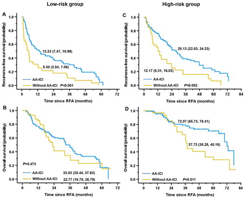 Figure 5. Adjuvant AA-ICI treatment following curative RFA exhibited more benefit in early-stage hepatocellular carcinoma patients in high-risk group in the pooled cohort D. Kaplan-Meier curves for RFS (A) and OS (B) of patients in low-risk group with adjuvant AA-ICI treatment or not. Kaplan-Meier curves for RFS (C) and OS (D) of patients in high-risk group with adjuvant AA-ICI treatment or not. RFA: radiofrequency ablation; RFS: recurrence-free survival; OS: overall survival; AA-ICI: anti-angiogenesis target therapy plus immune checkpoint inhibitor.