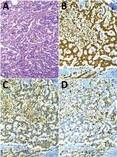 Figure 4. Medium-power (×40) photomicrographs of the neuroendocrine tumour (NET), showing its cellular growth pattern (A) and (in three adjacent sections) its immunoreactivity to antisera raised against pan-cytokeratins (B), CgA (C), and ghrelin (D), respectively.