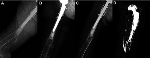 Figure 5 An 81-year-old woman was admitted to the hospital with a transfer fracture in the femur shaft. (A) On simple radiography, a fracture of the left femur around the femur stem with angulation and shortening was observed. (B) A 12-week radiograph after the sponge cast was applied. (C) A 20-week radiograph after sponge casting, which shows the union of the fracture. (D) Computerized tomography of the femur.
