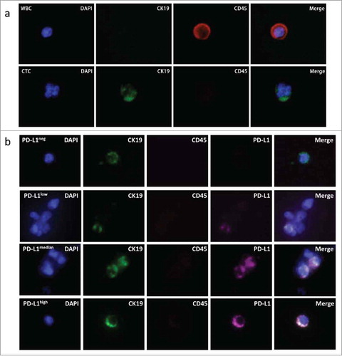 Figure 3. Assessment of PD-L1 expression on CTCs. (a) Represent CTC enriched with Pep@MNPs. WBC: white blood cell, characterized by DAPI+ CK19- CD45+; CTC: circulating tumor cell, characterized by DAPI+ CK19+ CD45-. (b) Represent CTCs with different PD-L1 levels isolated from one patient. In order from top to bottom, it was PD-L1 negative (PD-L1neg), lowly expressed (PD-L1low), medially expressed (PD-L1medium) and strongly expressed (PD-L1high) CTC, respectively.