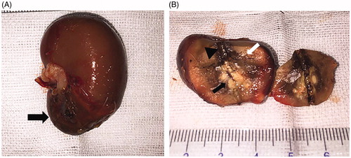 Figure 9. Gross pathological examination after ablation. (A) Ablated tumor was located in the lower pole of the left kidney (black arrow). (B) The ablative change showed a black carbonized needle track along the microwave antenna path (black triangle) with yellow-white coagulation necrosis in the center of the original tumor (black arrow). Another gray yellow coagulation necrosis area was also found besides the tumor (white arrow). Moreover, a dark red band congestion and edema area was detected around the ablative lesion.