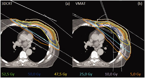 Figure 1. Dose distributions for one patient in the breast area on a transverse slice. CTVp is represented with orange, CTVn_IMN is represented with purple and flash bolus is seashell. Lavender line is 20% isodose curve, yellow is 95% isodose curve, blue is the 100% isodose curve, and green is the 105% isodose curve. The thin white lines represent the beam configuration. Figure (a) representing 3DCRT, and figure (b) representing VMAT.