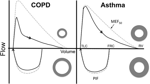 Figure 1. Flow-volume relationships for a theoretical patient with COPD (left hand panel) and for a patient with asthma (right hand panel) preformed using the technique for maximal inspiration described by Okazawa at all (4). Following a period of quiet breathing the patient takes a maximum inspiration from functional residual capacity (FRC) to total lung capacity TLC with a maximum expiration to residual volume (RV). From the expiratory limb the forced expiratory volume in one second (FEV1), forced vital capacity (FVC) are determined and maximum expiratory flow rate at 50% vital capacity (MEF50) is measured. In addition, maximum inspiratory flow (PIF) is measured from the inspiratory limb. For the patient with asthma, expiratory flow is diminished likely due to thickening of the airways with minimum compression during expiration and minimal tethering during inspiration. On the other hand, for the patient with COPD expiration is diminished in part due to compression of airways due to lost of parenchymal tethering; that is, the airways are functionally more dispensable. On inspiration the same airway is pulled open as illustrated by the adjacent donut shapes. As result the FEV1/FVC is reduced in both cases but more so the case of the patient was COPD. PIF/ MEF50 is increased in both cases; the more so in the case of patients with COPD, because of the relative preservation of inspiratory flow. As a result, using both indices would be predicted to better discrimination between the two forms of airways disease.