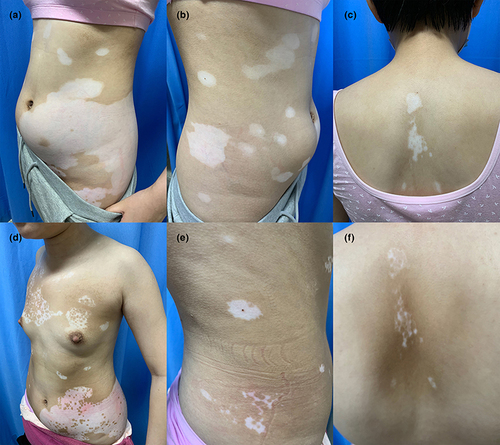 Figure 1 Clinical photographs of patient 1 before and after baricitinib treatment. Multiple, depigmented patches on the trunk. (a–c) Significant repigmentation on the trunk after twice-daily oral baricitinib application for 8 months. (d–f).