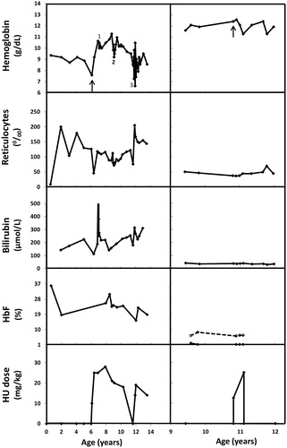 Figure 1. Laboratory parameters before and during HU treatment of patient with Hb Volga (left panels) and Hb Köln (right panels). Start of HU therapy is indicated by an arrow in the top panels. Period of cholelithiasis (1), pneumonia (2), and Parvo B19 induced aplastic crisis, requiring red blood cell transfusions (3), are indicated with numerals for the patient with Hb Volga. Percentages of Hb Köln are shown by a dashed line with open circles. Hb Volga was not detectable by IEF, but a heterozygous presence of the mutation was confirmed by sequencing.