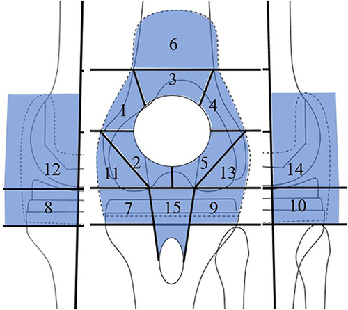 Figure 2 The knee joint was divided into the following 15 areas with grid lines for knee-synovitis mapping: 1) superomedial, 2) inferomedial, 3) supra, 4) superolateral, and 5) inferolateral patellofemoral joints; 6) suprapatellar pouch; 7) anteromedial, 8) posteromedial, 9) anterolateral, and 10) posterolateral tibial plateaus; 11) anteromedial, 12) posteromedial, 13) anterolateral, and 14) posterolateral femoral condyles; and 15) posterior patellar tendon.