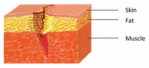 Figure 4 Schematic depiction of laceration wound.