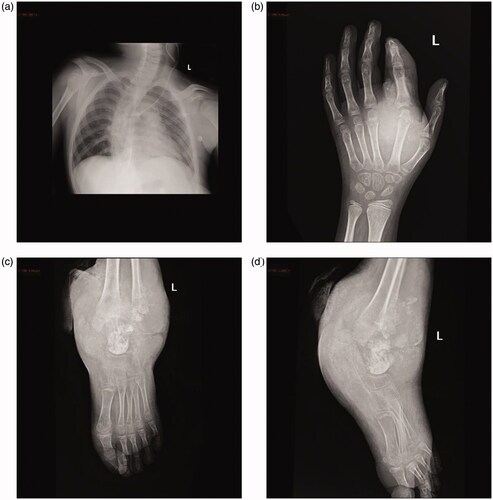 Figure 3. (a) Chest radiography showing thoracic scoliosis (anteroposterior and supine views). (b) X-ray image of the left wrist showing a soft tissue mass adjacent to the metacarpal and proximal to the second finger. (c) X-ray image of the left ankle showing a large soft tissue mass with intramass calcification.