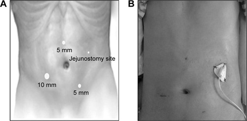 Figure 1 (A) Port positioning. (B) A 30-day postoperative view of incision of a 38-year-old male patient.