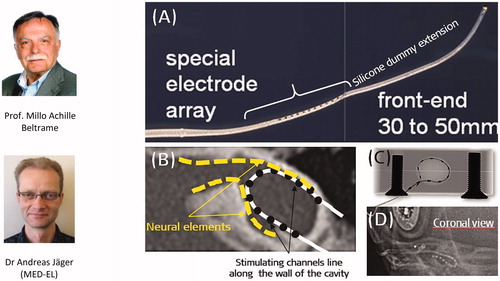 Figure 11. Special electrode array with silicone dummy extension conceptualised by Prof. Beltrame and realised by Dr. Andreas Jäger (A). Neural elements are believed to be present along the cavity wall, as shown by the yellow dotted line (B). X-ray image of the special electrode in a plastic cavity model (C); postoperative image showing special electrode inside the CC type cochlea (D). Image (D) courtesy of Dr. Mary Shanks, Kilmarnock.