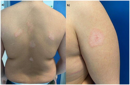 Figure 2. Erythematous follicular patches on the back (Figure 2(a)) and left shoulder (Figure 2(b)) after 18 months of treatment with ustekinumab.