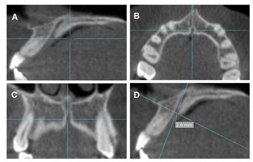 Figure 2 CBCT Images generated parallel to the IC opening in the: (A) sagittal, (B) axial, and (C) coronal planes. (D) Sagittal reconstruct showing the measurement of the width of IC at the palatal opening measured on the horizontal orientation line.