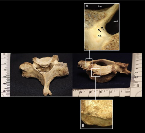 Figure 2. C6 vertebra, posterior–superior (image left) and anterior–superior (image right) views. Inset A: closeup of linear incised defects anterior and inferior to the defect across the right superior articular facet. Inset B: closeup of a defect on the right superior endplate.
