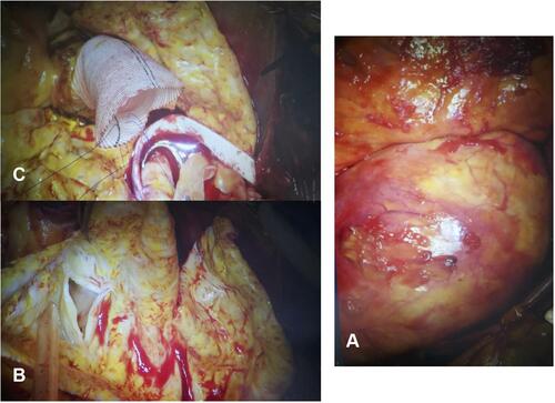 Figure 1 (A-C) Intraoperative view of the ascending aortic aneurysm, wrinkling intima (tree bark aspect).
