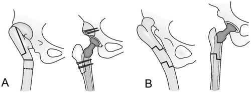 Figure 2. Osteotomies used for various deformities of the femur. The femoral shaft is usually transected distal to the lesser trochanter, as shown by the transverse solid line in (A). A dotted line demonstrates the most distal possible level of the osteotomy. A. Proximal shortening osteotomy with distal advancement of the greater trochanter (vertical solid line) in hips with a previous proximal Schanz osteotomy. B. Segmental shortening with angular correction for hips with a previous, more distal Schanz osteotomy. Copyright for the illustrations in this figure is owned by The Journal of Bone and Joint Surgery, Inc. (published in Eskelinen et al. Cementless total hip arthroplasty in patients with high congenital hip dislocation, J Bone Joint Surg Am. Citation2006; 88: 80-91). Reproduced with permission.