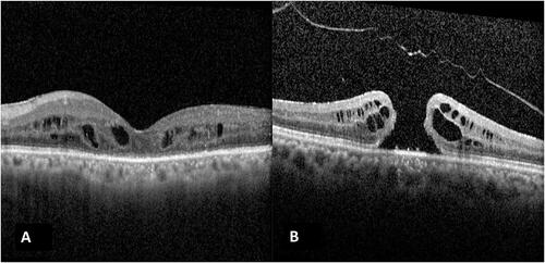 Figure 1 OCT image of a case labelled as Grade 4 PVD on OCT (A), but intraoperative TA staining determined a posterior hyaloid attachment (false-positive). Case (B) was labelled to have Grade 3 OCT (attached to the optic nerve head) although intraoperative staining showed that a complete PVD was present (false-negative).