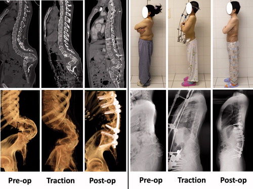 Figure 1. Case 1: Computed tomography (CT) revealed a congenital malformation in the lumbar region, and the lumbar spine appeared as if it was “completely folded up.” Treatment included HPT and anteroposterior fixation.