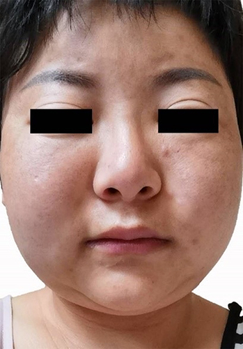 Figure 1 Photograph of the patient’s face before treatment. Facial swelling on the entire face and a protuberance under the inner corner of the left eye are observed. The symptoms developed on areas that received the mesotherapy injections.