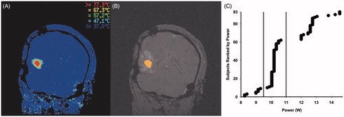 Figure 1. Example of an ablation with real-time magnetic resonance thermal imaging (A) and thermal damage estimate (B). Power groups were stratified per the cluster distributions observed in (C). Each data point represents a single case.