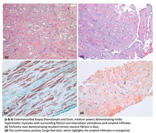 Figure 3. Histopathology images demonstrating cardiac amyloidosis