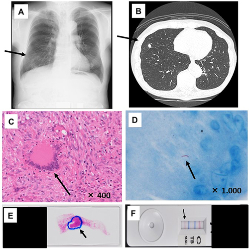 Figure 1 Chest X-ray/computed tomography (CT) findings and detection of the genes of Mycobacterium avium complex by tissue-direct polymerase chain reaction-based nucleic acid lateral flow immunoassay (tdPCR-NALFIA) from lung tissue in patient 1. (A and B) Chest X-ray findings (A) and CT findings (B) of patient 1, respectively. The arrows indicate the abnormal nodules. (C and D): Magnified view of the section stained with hematoxylin-eosin (× 400) and Ziehl–Neelsen (× 1000), respectively. (E and F): Mycobacterium avium complex in the patient’s lung tissue section and tdPCR-NALFIA, respectively. The images show the granulomas (C and E), stained Mycobacterium (D) and the detected band (F), respectively (arrows).