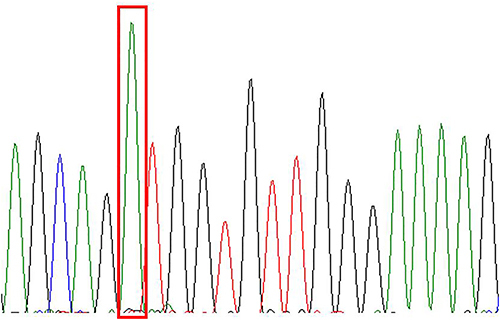 Figure 9 NRAS-Ex2c.35G>A (p.G12D).