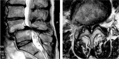 Figure 2. Sagittal (left) and axial (right) MR images showing severe spinal stenosis (10 mm2) with concomitant degenerative spondylolisthesis.