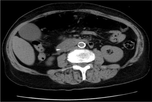 Fig. 3 Computed tomography abdomen pelvis: inflamed pancreas consistent with acute pancreatitis.