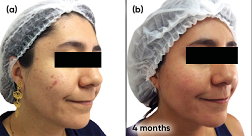 Figure 12 Case study 5 improvement on right-hand side of face, baseline to 4 months (a) Baseline (b) 4 months with oral contraceptive (ethinylestradiol plus chlormadinone) plus AZA 15% gel twice a day.