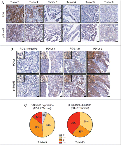 Figure 3. PD-L1 and phosphorylated Smad2 in NSCLC tumor samples. (A) IHC staining for PD-L1 and p-Smad2 in lung tumors (T047 microarray). Scale bar = 75 μm. (B) IHC staining of PD-L1 and p-Smad2 from matched samples of the LC819t tumor microarray. Images are representative of the indicated PD-L1 staining intensity category (0, 1+, 2+, 3+). Scale bar = 75 μm. Insets show an enlarged view of tumor cell staining. (C) Categorization of p-Smad2 staining intensity from PD-L1 negative and positive tumors.