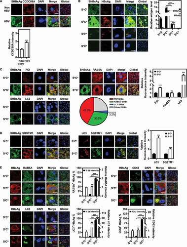 Figure 1. HBV infection regulates CCDC88A expression and the vesicular trafficking system in the liver tissues of patients with HBV infection. The liver tissues of patients with HBV infection were fixed and stained, and then the expression levels of CCDC88A (A), the distribution of SHBsAg and HBcAg (B), the fluorescence intensity of the markers of ER (PDI), early endosome (RAB5A), and autophagosome (LC3) and the colocalization of these compartments with SHBsAg (C), the fluorescence intensity of SQSTM1 and the colocalization of SQSTM1 with SHBsAg or LC3 (D), and the colocalization of HBcAg with the markers of early endosome (RAB5A), late endosome (CD63), and autophagosome (LC3) (E) were evaluated by immunofluorescence. SmCl: HBsAgmiddle HBcAglow; ShCh: HBsAghigh HBcAghigh; SlCm: HBsAglow HBcAgmiddle; SnCn: HBsAgnegative HBcAgnegative. The fluorescence intensity of target proteins, and the colocalization between target proteins or with organelle marker proteins were analyzed using ImageJ software. The results presented in the graphs were calculated from at least 5 cells. Scale bar: 10 μm. *, #p < 0.05; **, ##p < 0.01; ***, ###p < 0.001; ns, not significant.