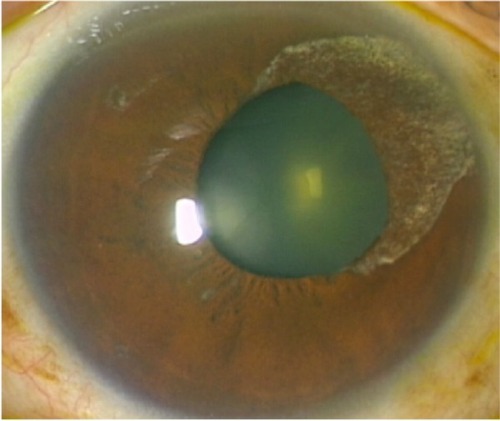 Figure 2 Ocular findings observed after treatment was started.